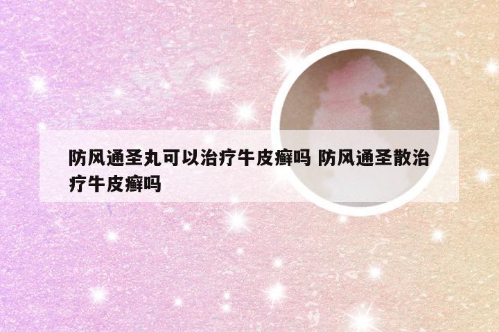 防风通圣丸可以治疗牛皮癣吗 防风通圣散治疗牛皮癣吗