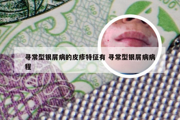 寻常型银屑病的皮疹特征有 寻常型银屑病病程