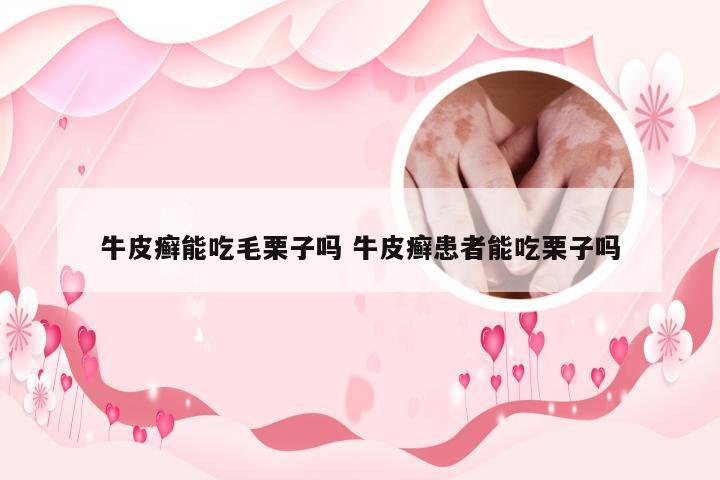 牛皮癣能吃毛栗子吗 牛皮癣患者能吃栗子吗