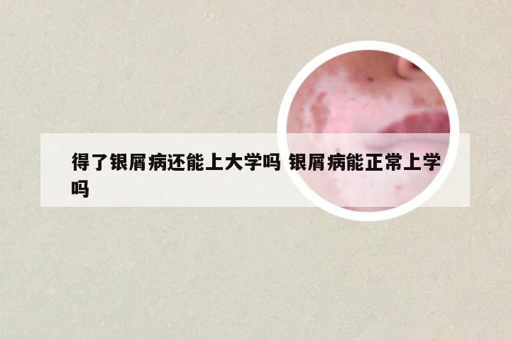 得了银屑病还能上大学吗 银屑病能正常上学吗