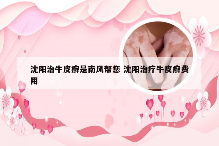 沈阳治牛皮癣是南风帮您 沈阳治疗牛皮癣费用