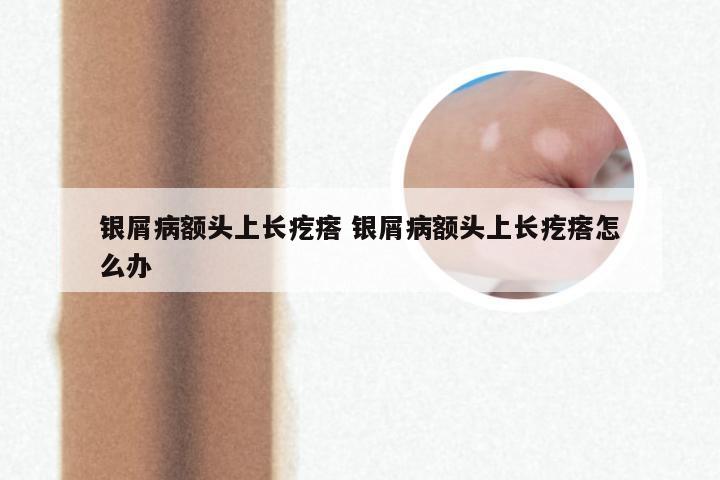 银屑病额头上长疙瘩 银屑病额头上长疙瘩怎么办