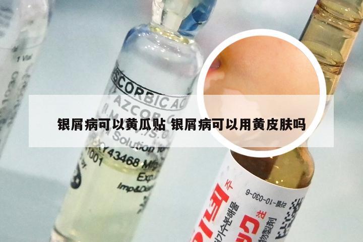 银屑病可以黄瓜贴 银屑病可以用黄皮肤吗