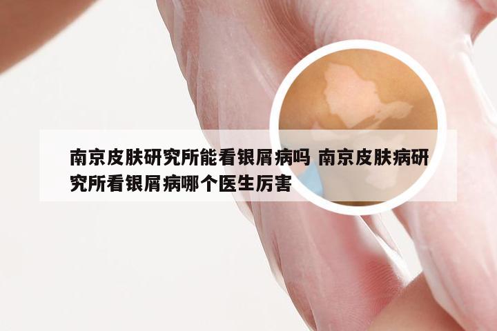 南京皮肤研究所能看银屑病吗 南京皮肤病研究所看银屑病哪个医生厉害
