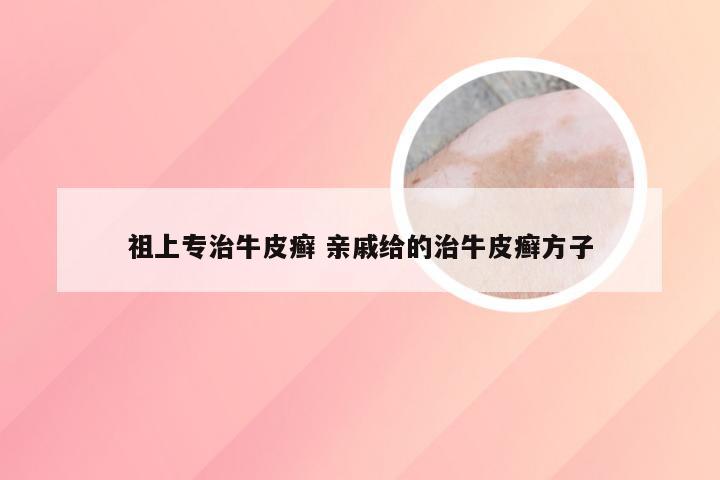 祖上专治牛皮癣 亲戚给的治牛皮癣方子