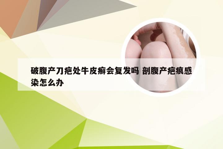 破腹产刀疤处牛皮癣会复发吗 剖腹产疤痕感染怎么办
