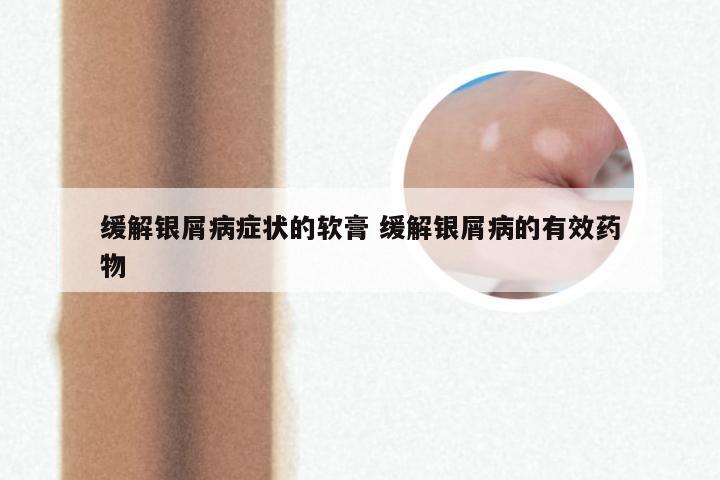 缓解银屑病症状的软膏 缓解银屑病的有效药物