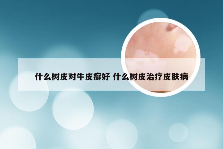 什么树皮对牛皮癣好 什么树皮治疗皮肤病