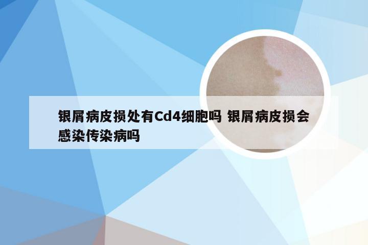 银屑病皮损处有Cd4细胞吗 银屑病皮损会感染传染病吗