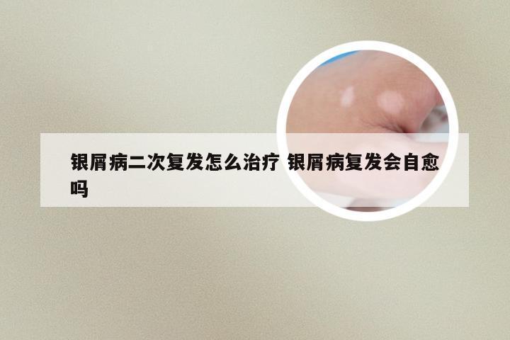 银屑病二次复发怎么治疗 银屑病复发会自愈吗