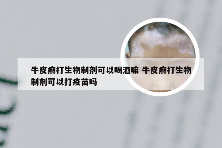 牛皮癣打生物制剂可以喝酒嘛 牛皮癣打生物制剂可以打疫苗吗
