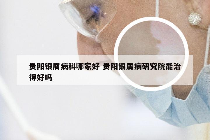 贵阳银屑病科哪家好 贵阳银屑病研究院能治得好吗