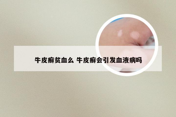 牛皮癣贫血么 牛皮癣会引发血液病吗