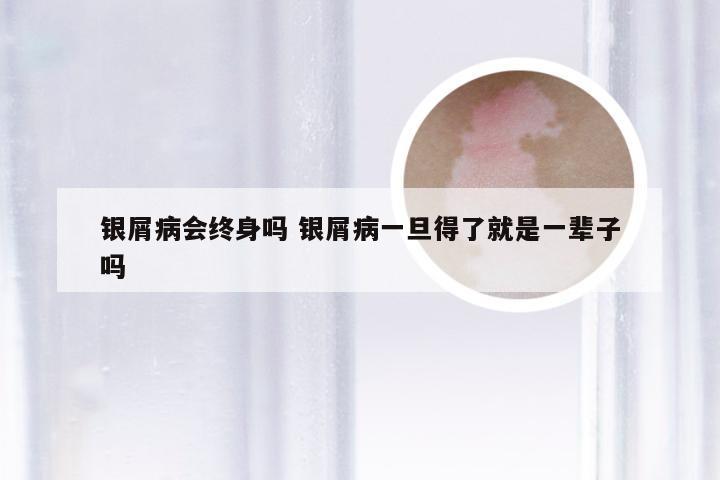 银屑病会终身吗 银屑病一旦得了就是一辈子吗