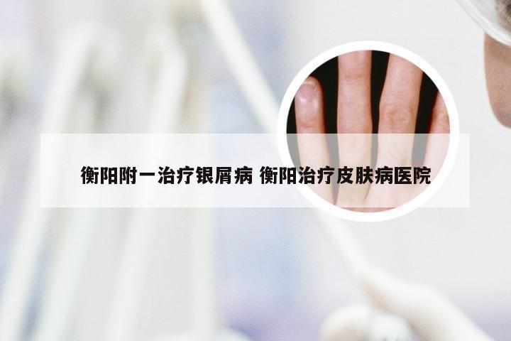 衡阳附一治疗银屑病 衡阳治疗皮肤病医院