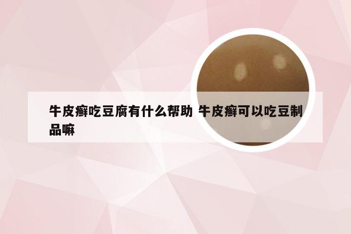 牛皮癣吃豆腐有什么帮助 牛皮癣可以吃豆制品嘛