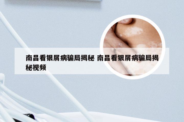 南昌看银屑病骗局揭秘 南昌看银屑病骗局揭秘视频
