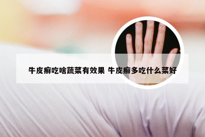 牛皮癣吃啥蔬菜有效果 牛皮癣多吃什么菜好