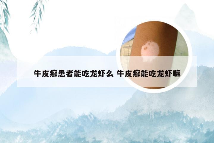 牛皮癣患者能吃龙虾么 牛皮癣能吃龙虾嘛