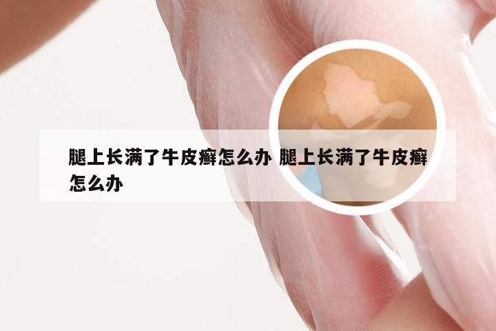 腿上长满了牛皮癣怎么办 腿上长满了牛皮癣怎么办
