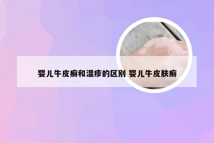 婴儿牛皮癣和湿疹的区别 婴儿牛皮肤癣
