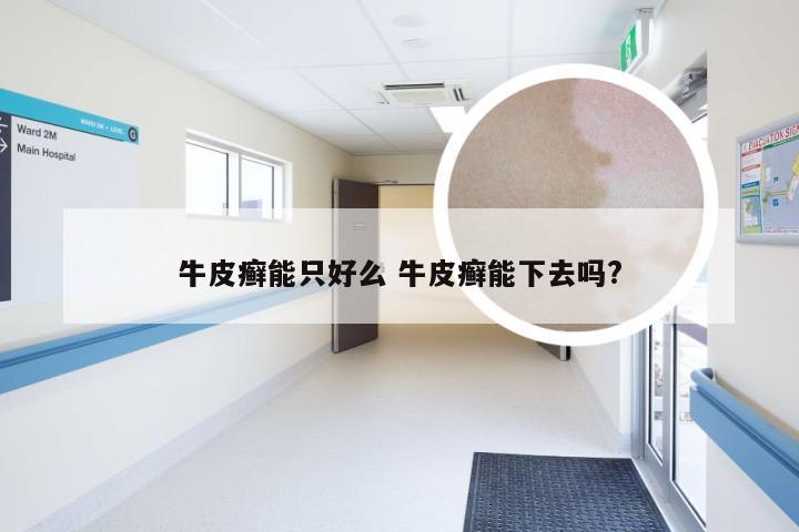 牛皮癣能只好么 牛皮癣能下去吗?