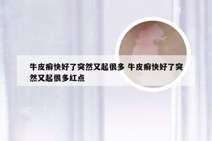 牛皮癣快好了突然又起很多 牛皮癣快好了突然又起很多红点