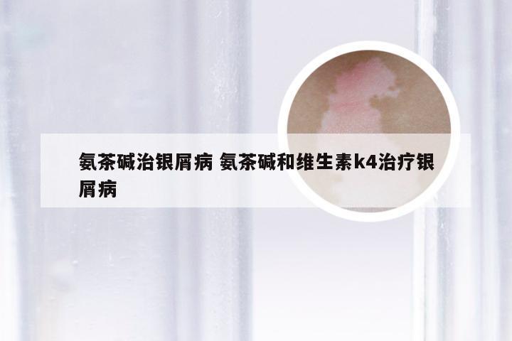 氨茶碱治银屑病 氨茶碱和维生素k4治疗银屑病