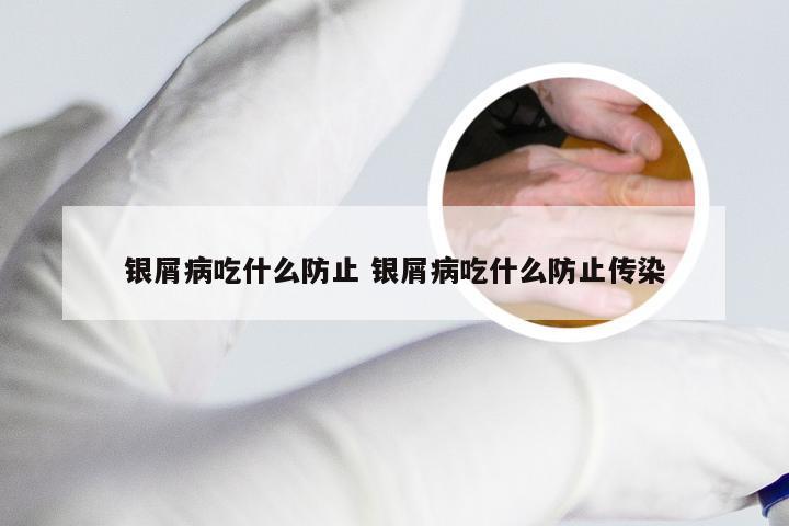 银屑病吃什么防止 银屑病吃什么防止传染