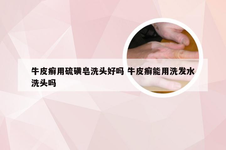 牛皮癣用硫磺皂洗头好吗 牛皮癣能用洗发水洗头吗