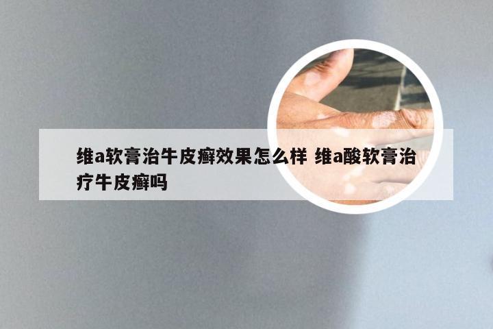 维a软膏治牛皮癣效果怎么样 维a酸软膏治疗牛皮癣吗