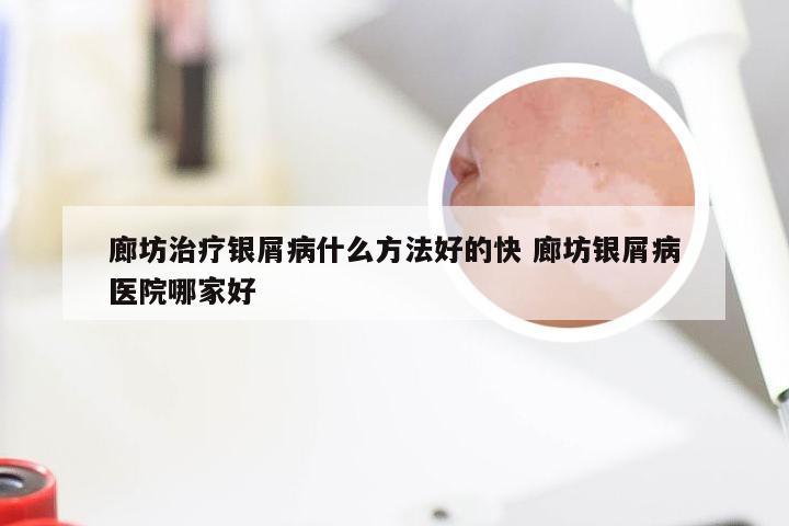 廊坊治疗银屑病什么方法好的快 廊坊银屑病医院哪家好