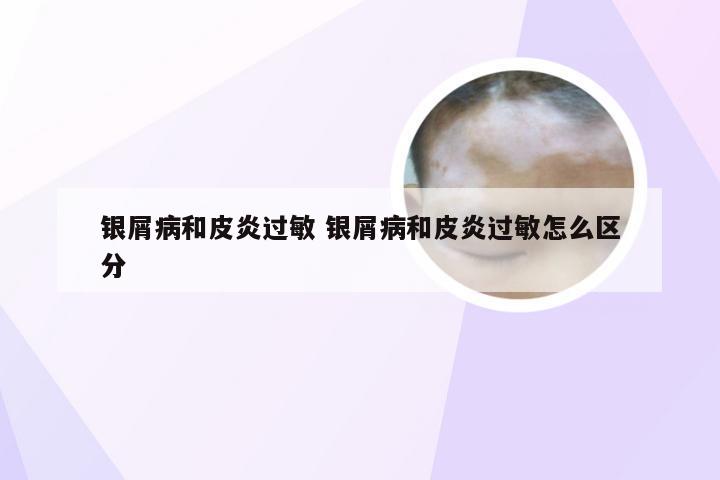 银屑病和皮炎过敏 银屑病和皮炎过敏怎么区分