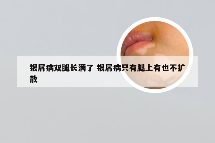 银屑病双腿长满了 银屑病只有腿上有也不扩散
