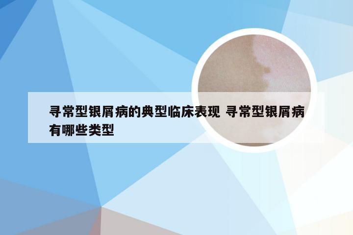 寻常型银屑病的典型临床表现 寻常型银屑病有哪些类型