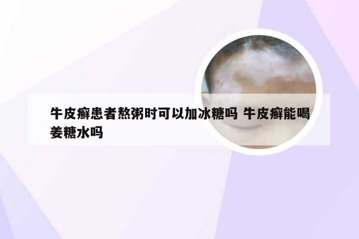 牛皮癣患者熬粥时可以加冰糖吗 牛皮癣能喝姜糖水吗