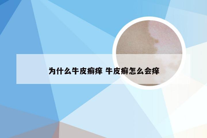 为什么牛皮癣痒 牛皮癣怎么会痒