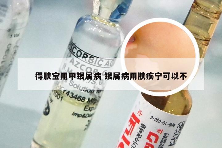 得肤宝用甲银屑病 银屑病用肤疾宁可以不