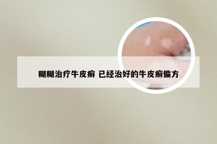 糊糊治疗牛皮癣 已经治好的牛皮癣偏方