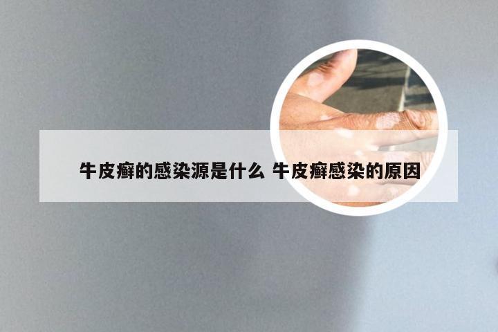 牛皮癣的感染源是什么 牛皮癣感染的原因