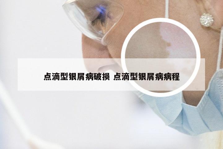 点滴型银屑病破损 点滴型银屑病病程