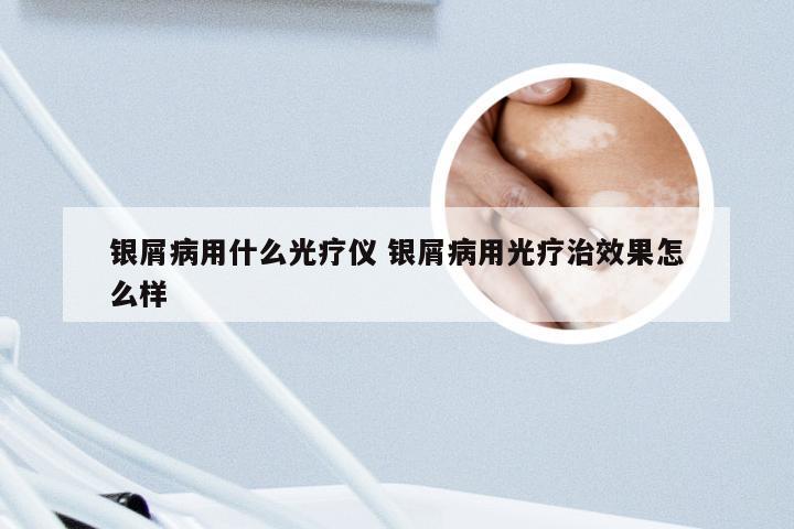 银屑病用什么光疗仪 银屑病用光疗治效果怎么样