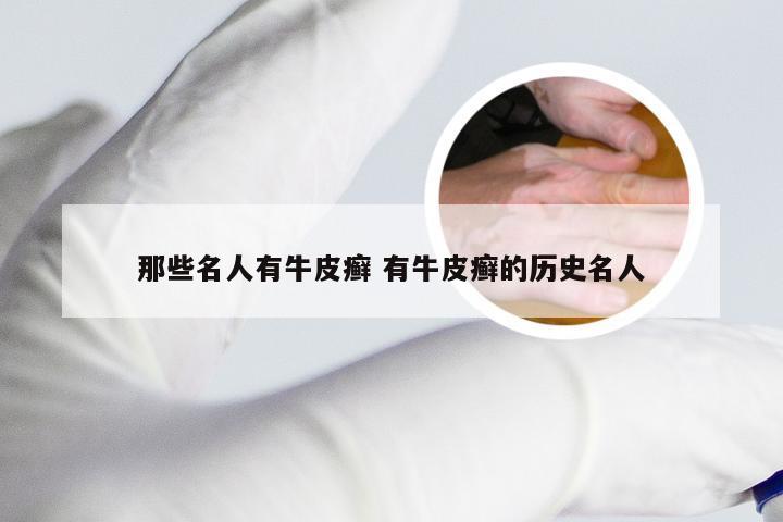 那些名人有牛皮癣 有牛皮癣的历史名人