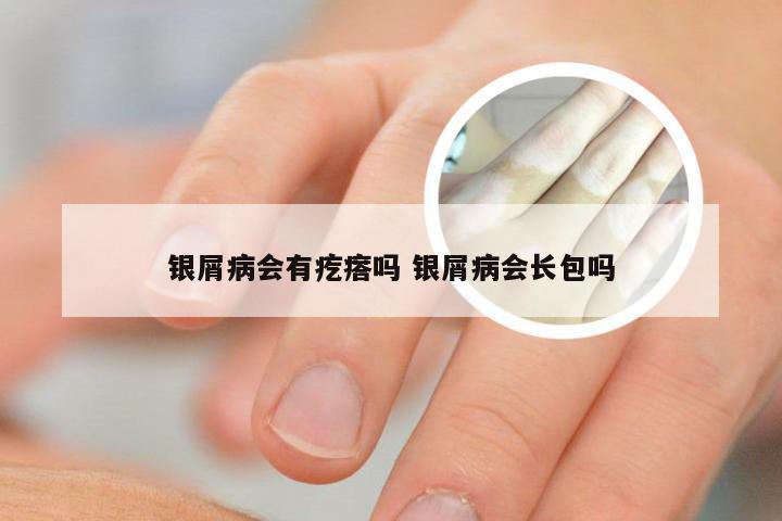 银屑病会有疙瘩吗 银屑病会长包吗