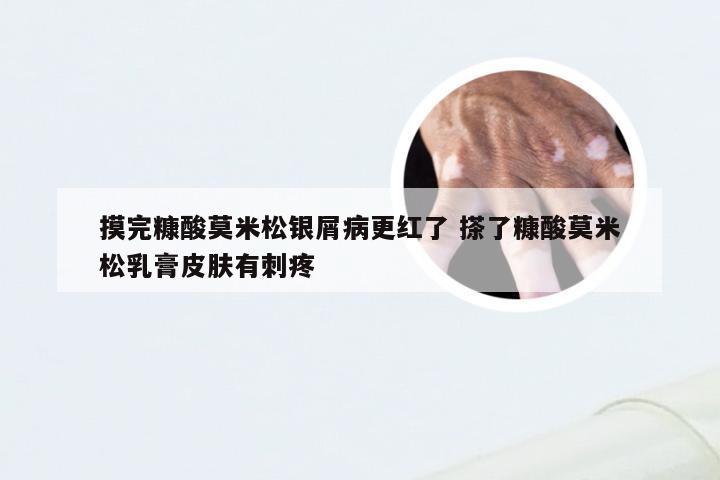 摸完糠酸莫米松银屑病更红了 搽了糠酸莫米松乳膏皮肤有刺疼