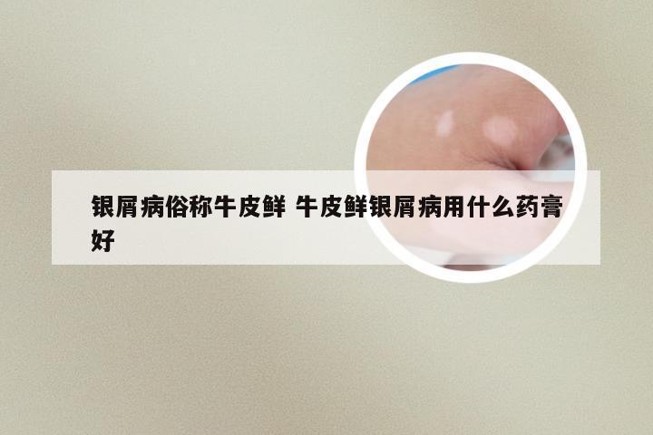 银屑病俗称牛皮鲜 牛皮鲜银屑病用什么药膏好