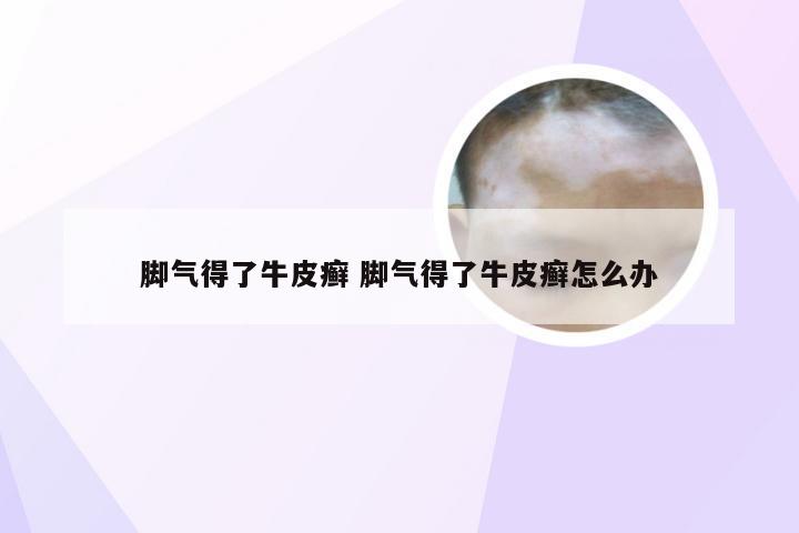 脚气得了牛皮癣 脚气得了牛皮癣怎么办