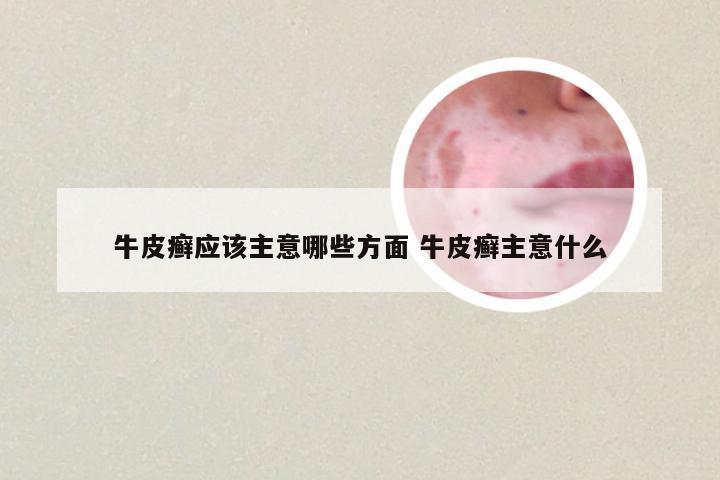 牛皮癣应该主意哪些方面 牛皮癣主意什么