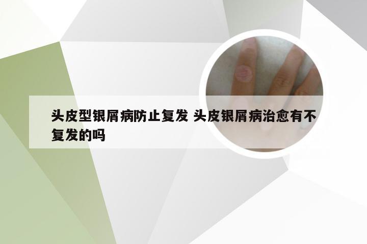 头皮型银屑病防止复发 头皮银屑病治愈有不复发的吗