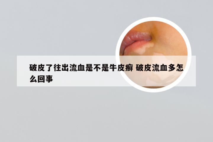 破皮了往出流血是不是牛皮癣 破皮流血多怎么回事
